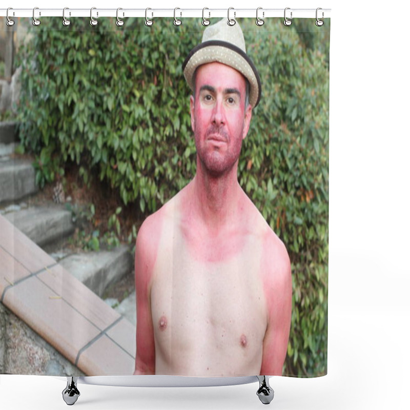 Personality  Sunburned Young Man With Extreme Tan Lines Shower Curtains