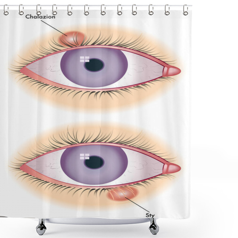 Personality  Chalazion & Sty Shower Curtains