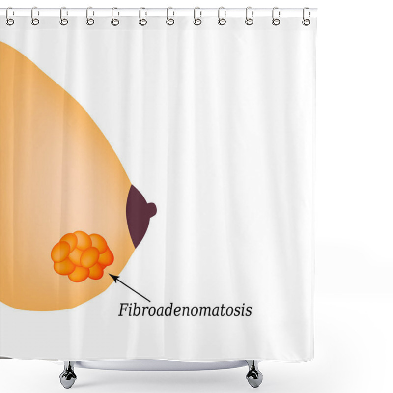 Personality  Fibrooadenomatosis In The Mammary Gland. World Breast Cancer Day. Vector Illustration On Isolated Background Shower Curtains