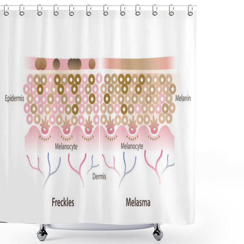 Personality  Cross Section Of Freckles And Melasma On Skin Layer Vector Illustration Isolated On White Background. Comparison Of Freckles Are Small Flat Brown Spots And Melasma Is Brown, Blue Gray Patches On Skin. Shower Curtains