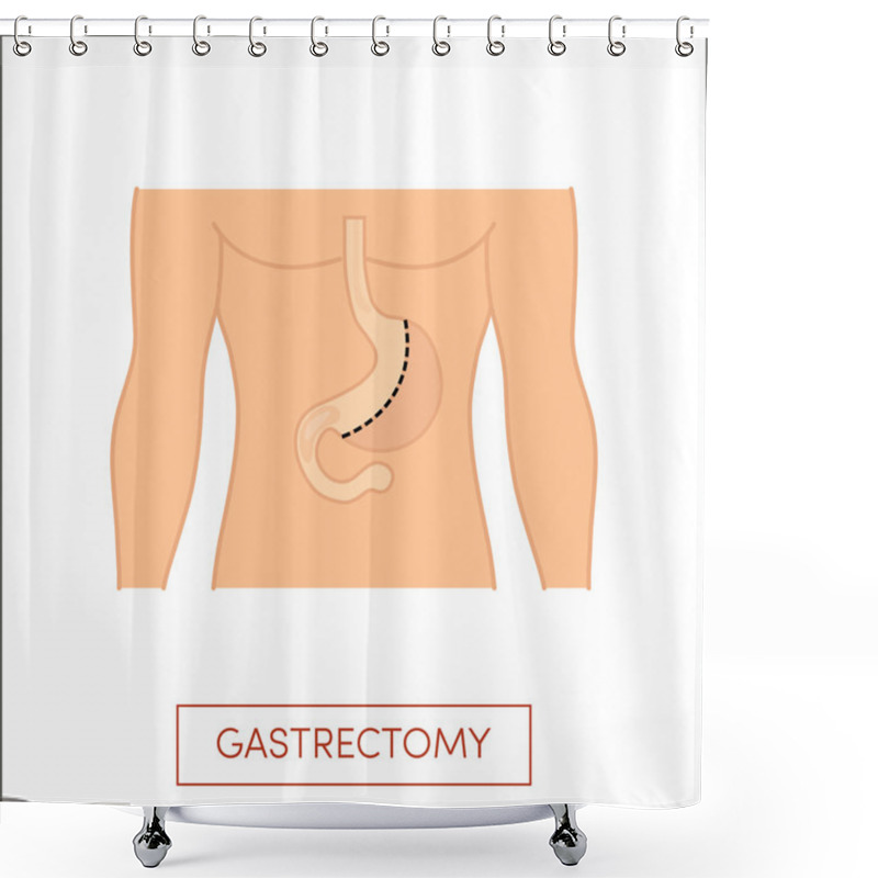 Personality  Vertical Gastrectomy Illustration  Shower Curtains