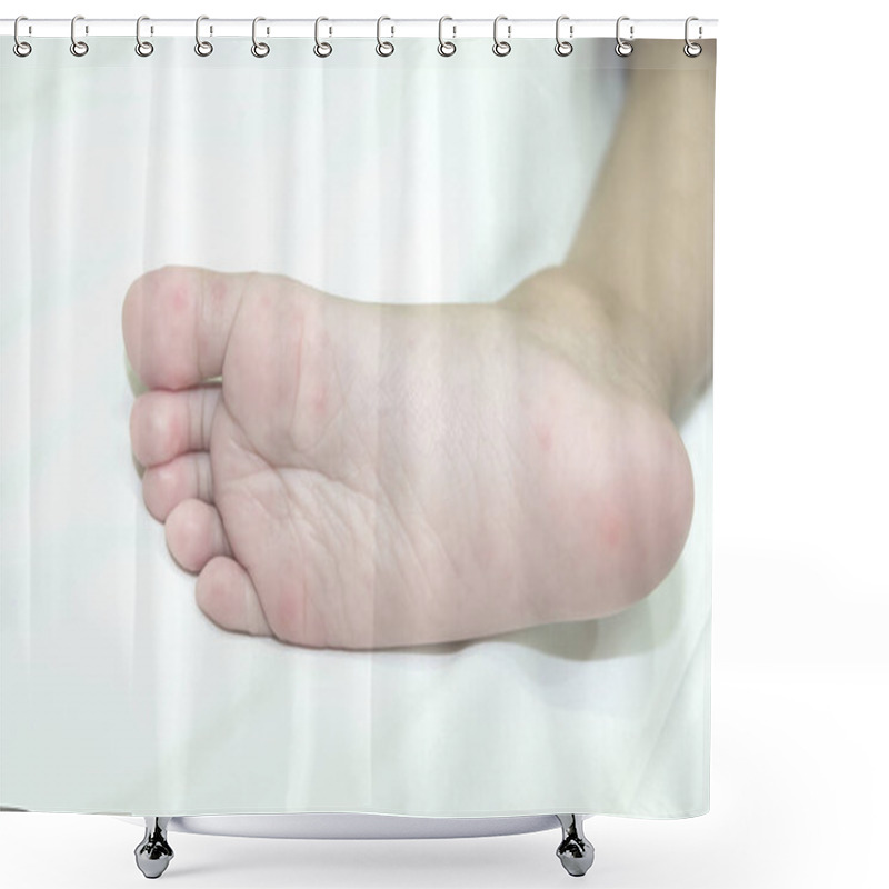 Personality  Allergic Rash Skin Of Baby's Right Foot Shower Curtains