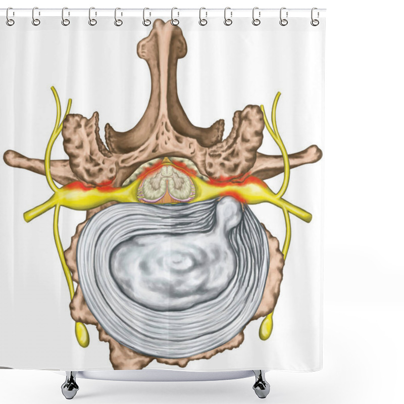 Personality  Stenosis, Lumbar Disk Herniation, Herniated Disc, Lumbar Vertebra, Osteophytes, Spondylophytes, Intervertebral Disk, Nervous System, Nerve Root, Spinal Cord, Arthrosis, Vertebra, Anatomy Of Human Skeletal And Nervous System, Superior View Shower Curtains