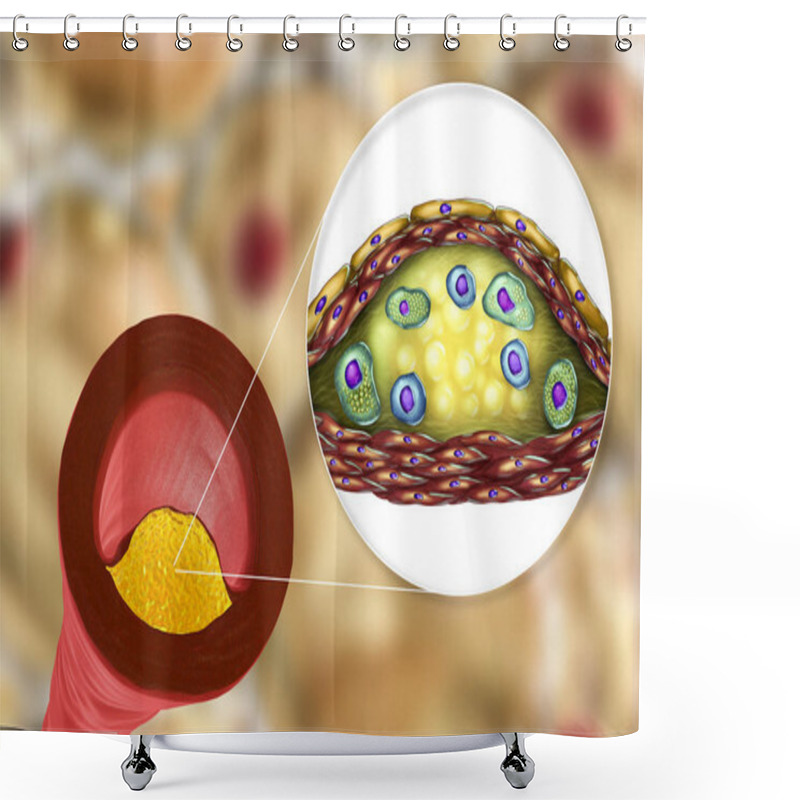 Personality  Atherosclerotic Plaque In Human Artery Shower Curtains