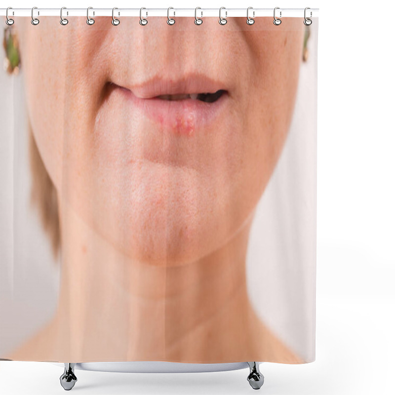 Personality  Close-up Of Female Lips Suffering From Herpes Shower Curtains