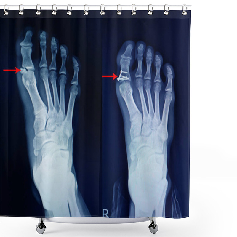 Personality  X-ray Foot Fracture Proximal Phalang And Surgery Fix Mini Plate  Shower Curtains