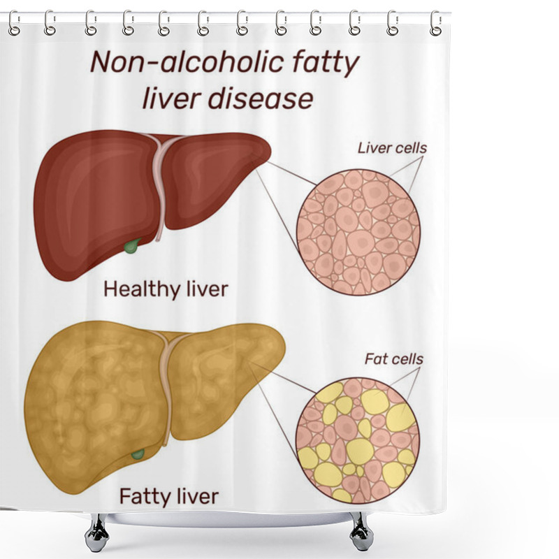 Personality  Illustration Of Non-alcoholic Fatty Liver Disease. For Comparison Shows The Healthy And Diseased Liver Shower Curtains