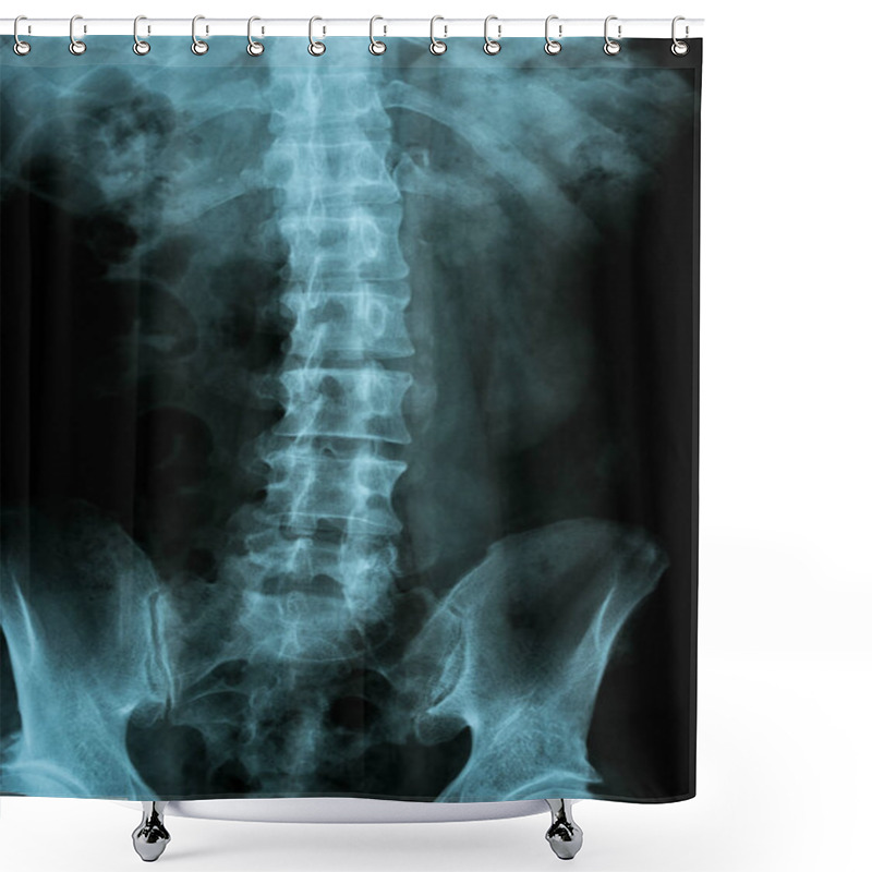 Personality  X-ray Image Of The Pelvis And Spinal Column Shower Curtains