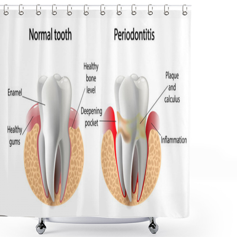 Personality  Vector Image Tooth  Periodontitis Disease Shower Curtains