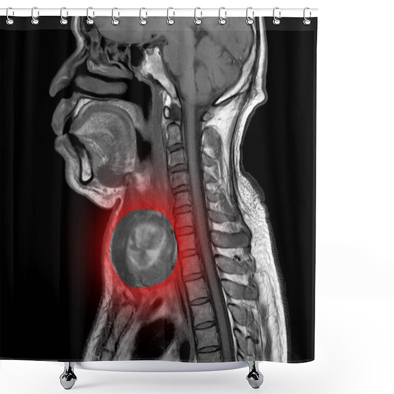 Personality  Magnetic Resonance Imaging (MRI) Of Neck, Shower Curtains