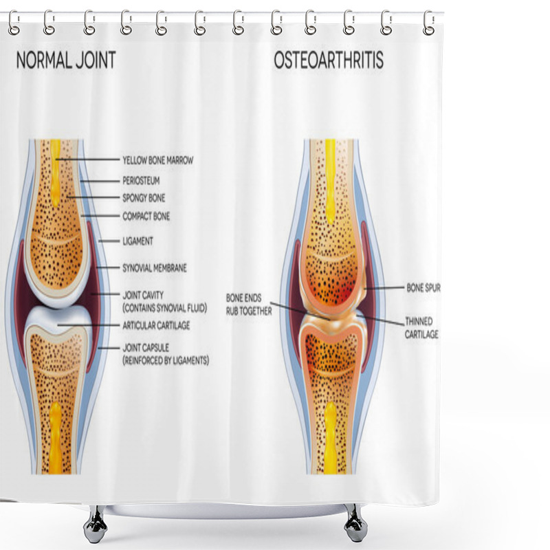 Personality  Osteoarthritis And Normal Joint Anatomy Shower Curtains