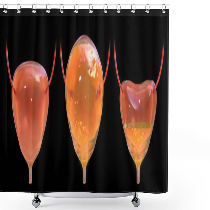 Personality  Overactive Bladder. Urinary Bladder Empty, Normal Full, And Overactive, 3D Illustration. Nonlabelled Version Of The Image Shower Curtains