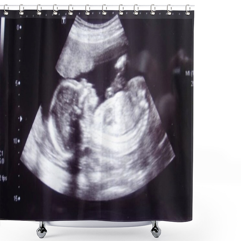 Personality  Closeup Shot Of An Obstetric Ultrasonography Shower Curtains