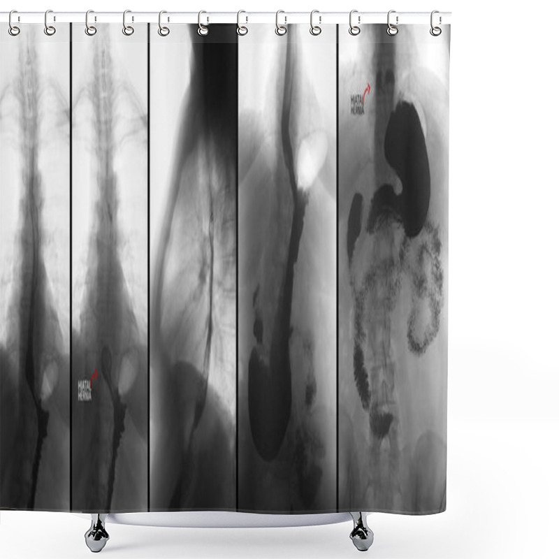 Personality  X-ray Of The Upper Gastrointestinal Tract (UGI) With Barium. Hiatal Hernia. Negative. Marker. Shower Curtains