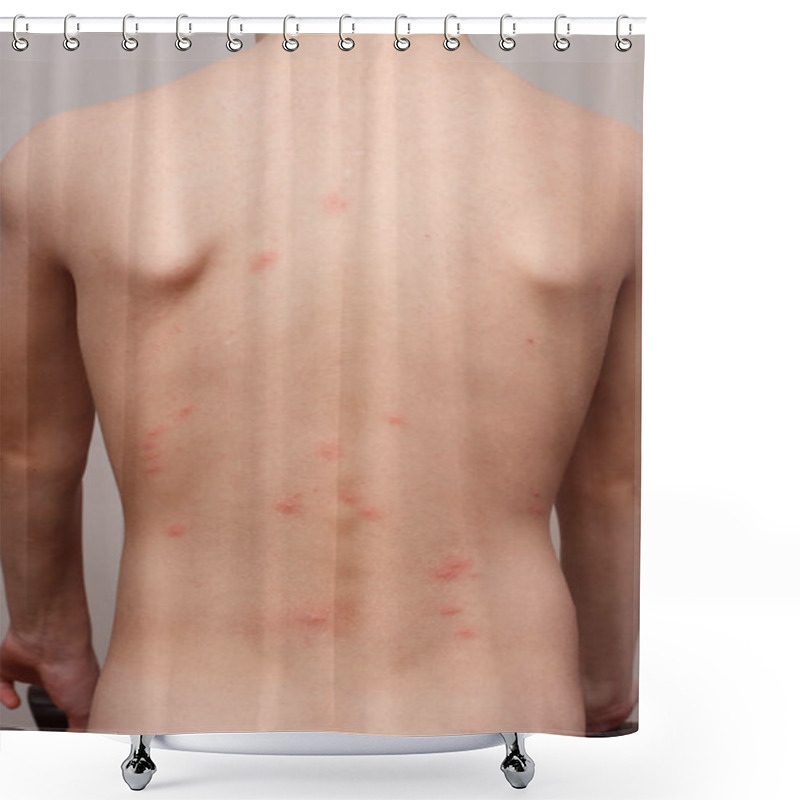 Personality  Insect Bites Of A Bedbug Such As Cimex Lectularius Or Cimex Hemipterus On The Child's Body After Returning From A Vacation Tourist Trip From Another City Shower Curtains