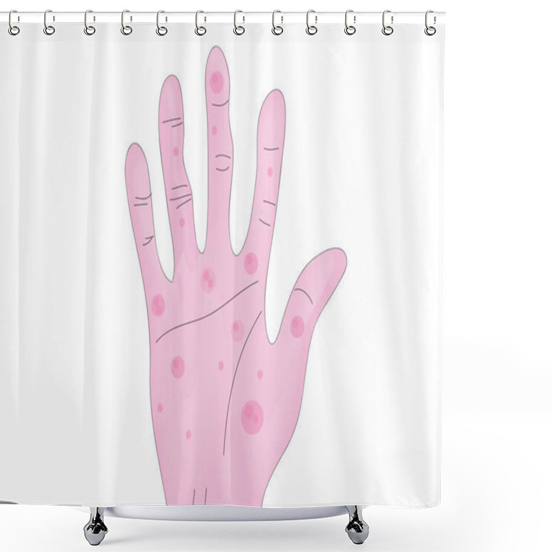 Personality  Janeway Lesion On The Hand  Shower Curtains