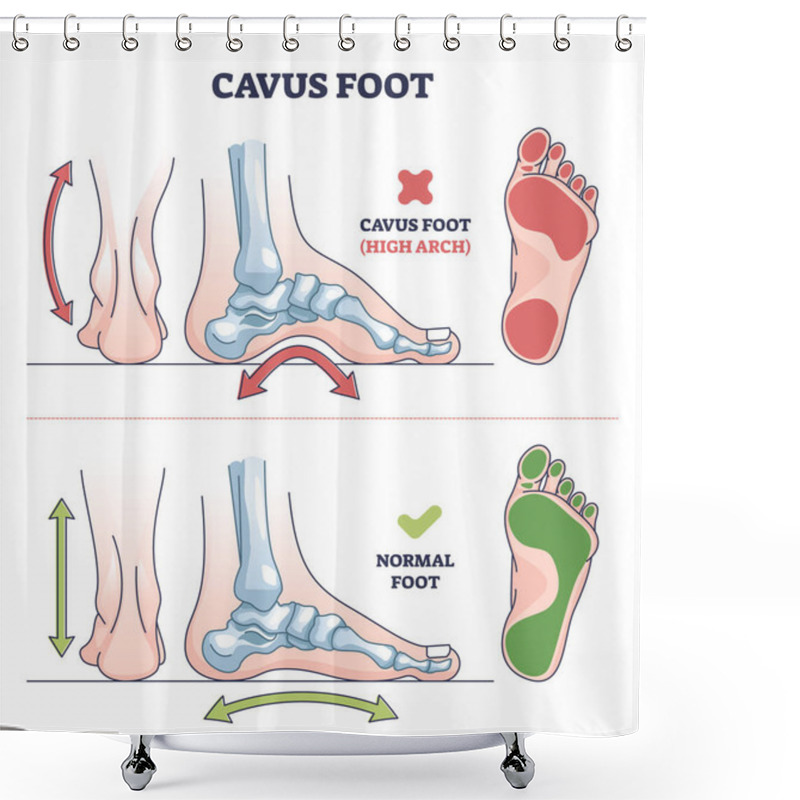 Personality  Cavus Foot With Abnormal High Arch Condition To Feet Bones Outline Diagram. Labeled Educational Medical Deformation Compared With Healthy Model Vector Illustration. Orthopedic Skeletal Pathology. Shower Curtains