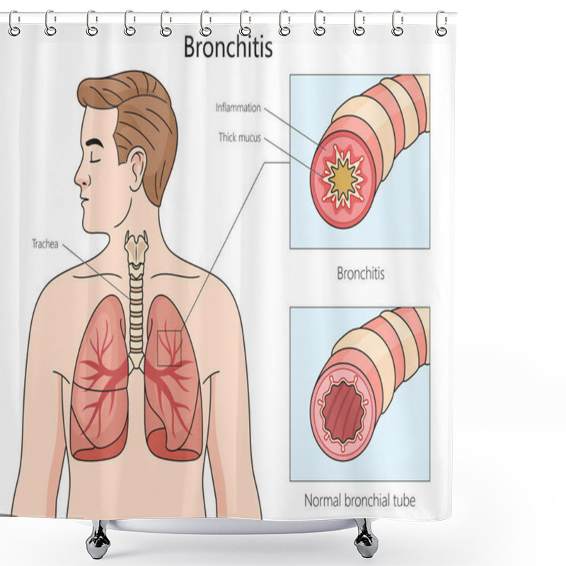 Personality  Healthy And Bronchitis Affected Bronchial Tubes, With A Focus On Inflammation And Mucus Buildup Structure Diagram Hand Drawn Schematic Vector Illustration. Medical Science Educational Illustration Shower Curtains