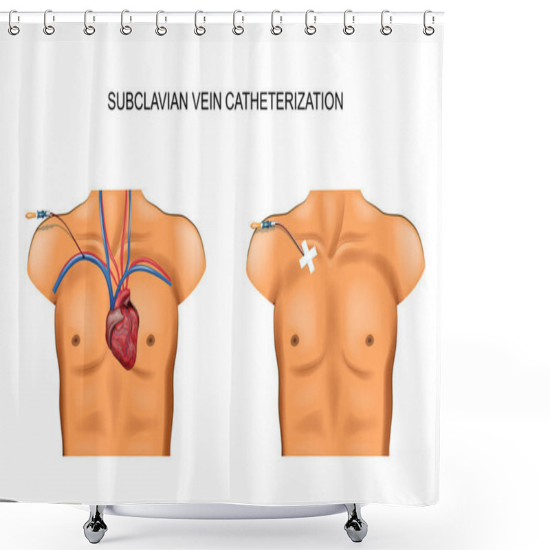 Personality  Subclavian Vein Catheterization Shower Curtains