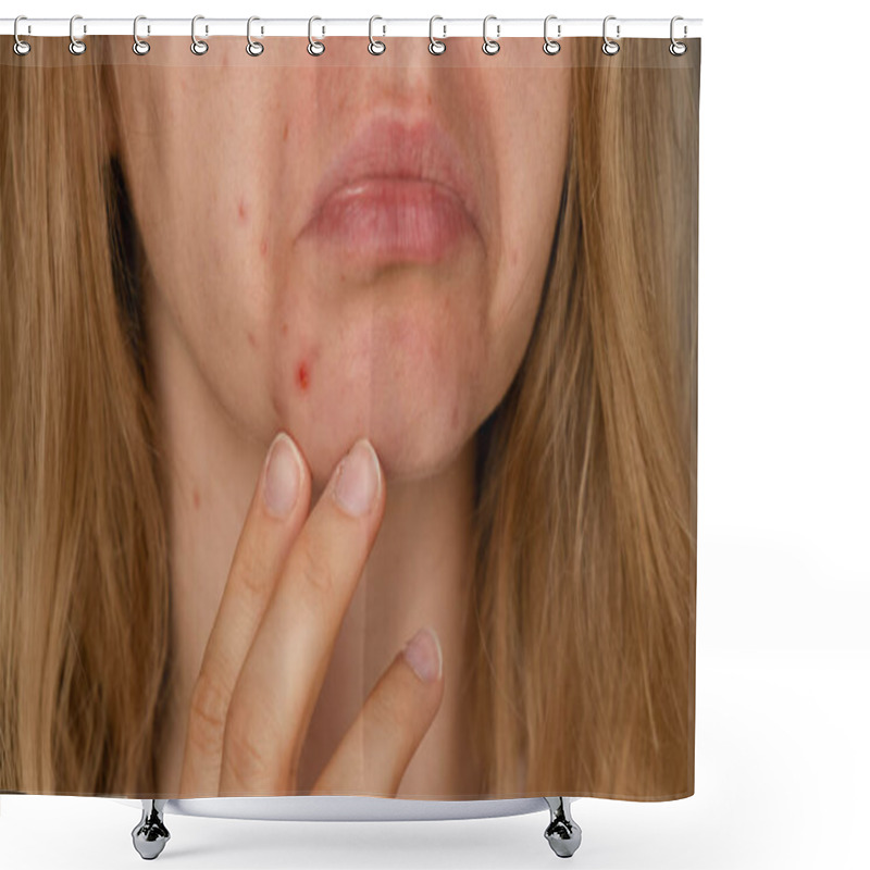 Personality  Unrecognizable Woman Upset Smiling Showing Her Acne On Face. Acceptance Real Skin Imperfection Close-up Acne On Womans Face With Rash Skin ,scar And Spot That Allergic To Cosmetics. Problem Skincare Shower Curtains