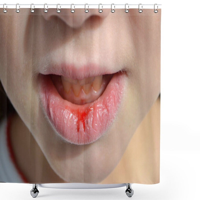 Personality  Dry And Damaged Lips Of A Girl. Close-up. Lip Fissure And Bleeding. Sick Cracked Damaged Tissue. Dry Lips With Cracks, Dry Mouth, Closeup Face With Brittle And Dry Lips, Dehydration High Quality Photo Shower Curtains