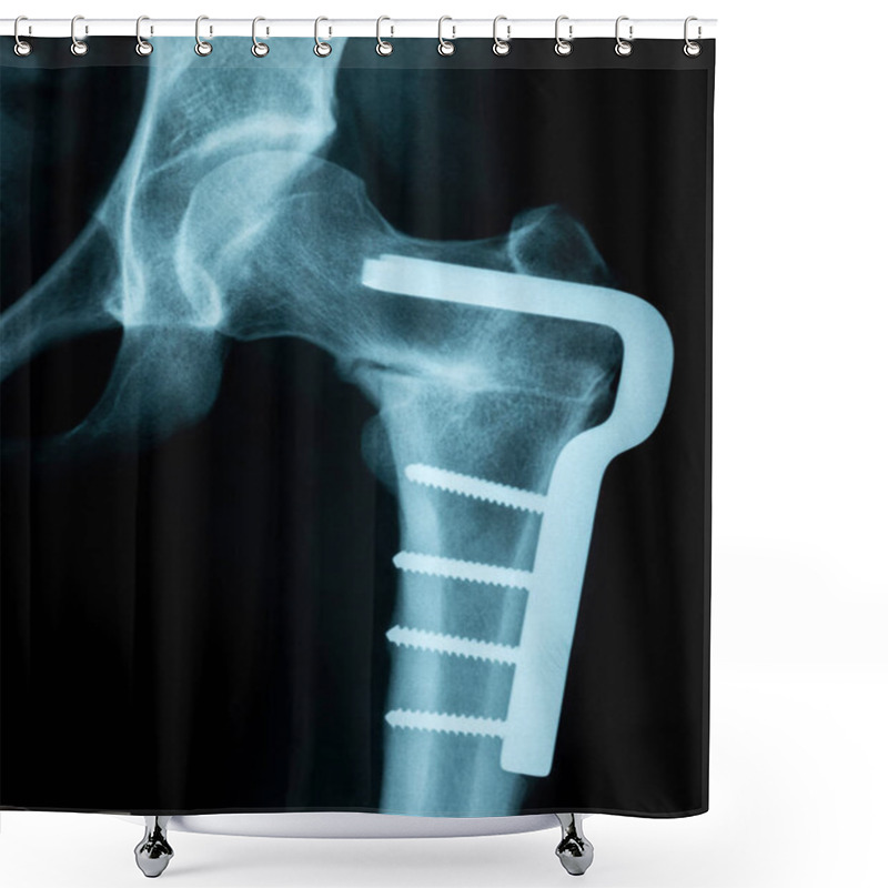 Personality  X-Ray Image Of A Broken Pelvis/hip With Metal Pins Holding It To Shower Curtains