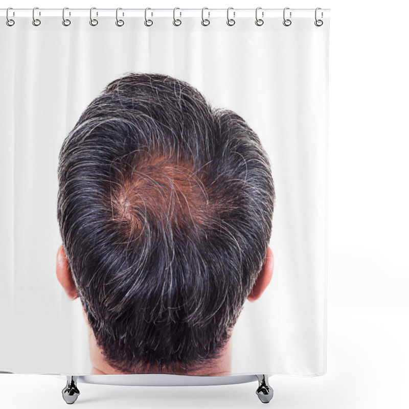 Personality  Hair Loss And Grey Hair, Male Head With Hair Loss Symptoms Back  Shower Curtains