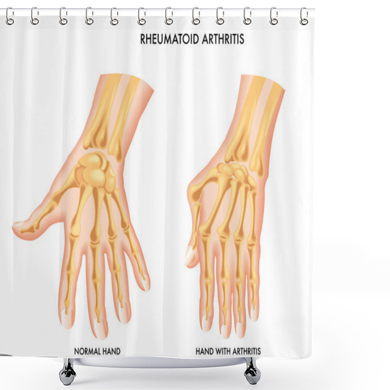 Personality  Rheumatoid Arthritis Shower Curtains