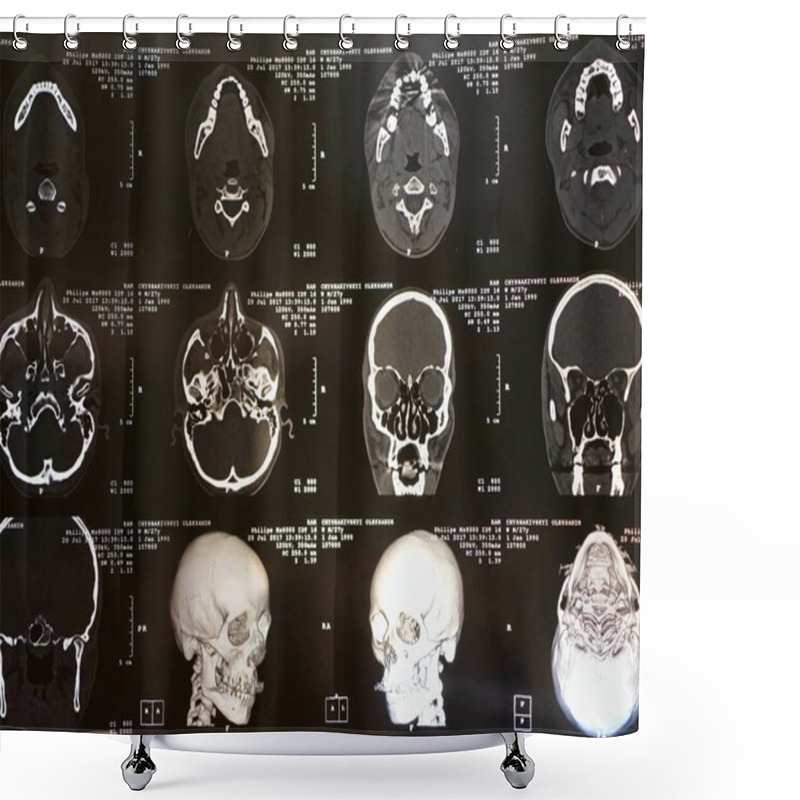 Personality  MRI Of The Human Brain Of A Patient With Multiple Sclerosis Of The Initial Stage. Close-up X-ray Vertical Shower Curtains