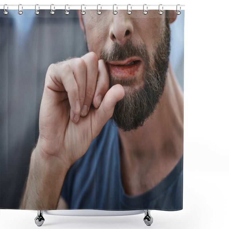 Personality  Cropped View Of Anxious Man With Beard Biting His Lips Till Blood During Depressive Episode Shower Curtains