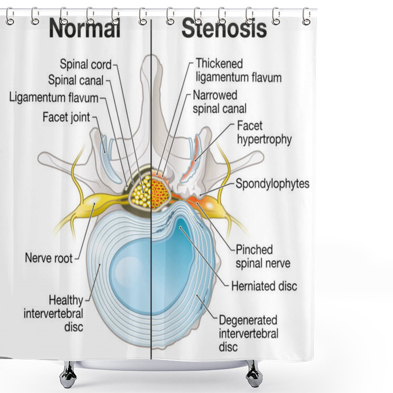 Personality  Illustration Showing Spinal Canal Stenosis Lumbar Vertebra With Intervertebral Disc And Herniated Nucleus Pulposus Shower Curtains