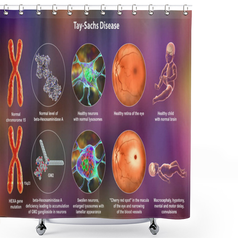 Personality  Tay-Sachs Disease, 3D Illustration. A Genetic Disorder That Progressively Destroys Brain Neurons, Is Caused By A Mutation In The HEXA Gene Of Chromosome 15 Leading To Deficiency Of Hexosaminidase A Shower Curtains