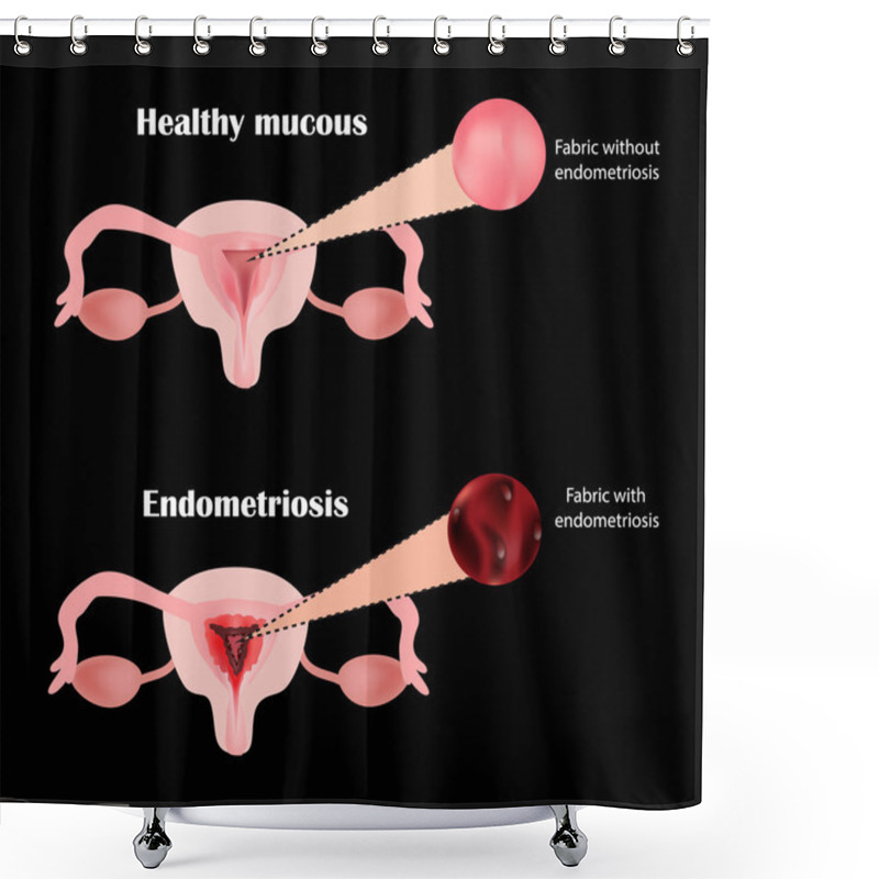 Personality  Endometriosis. The Structure Of The Pelvic Organs. Adenomyosis. The Endometrium. Vector Illustration Shower Curtains