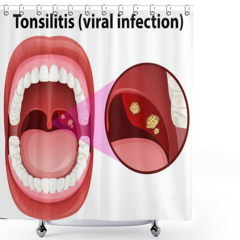 Personality  A Human Mouth Tonsillitis Infection Illustration Shower Curtains