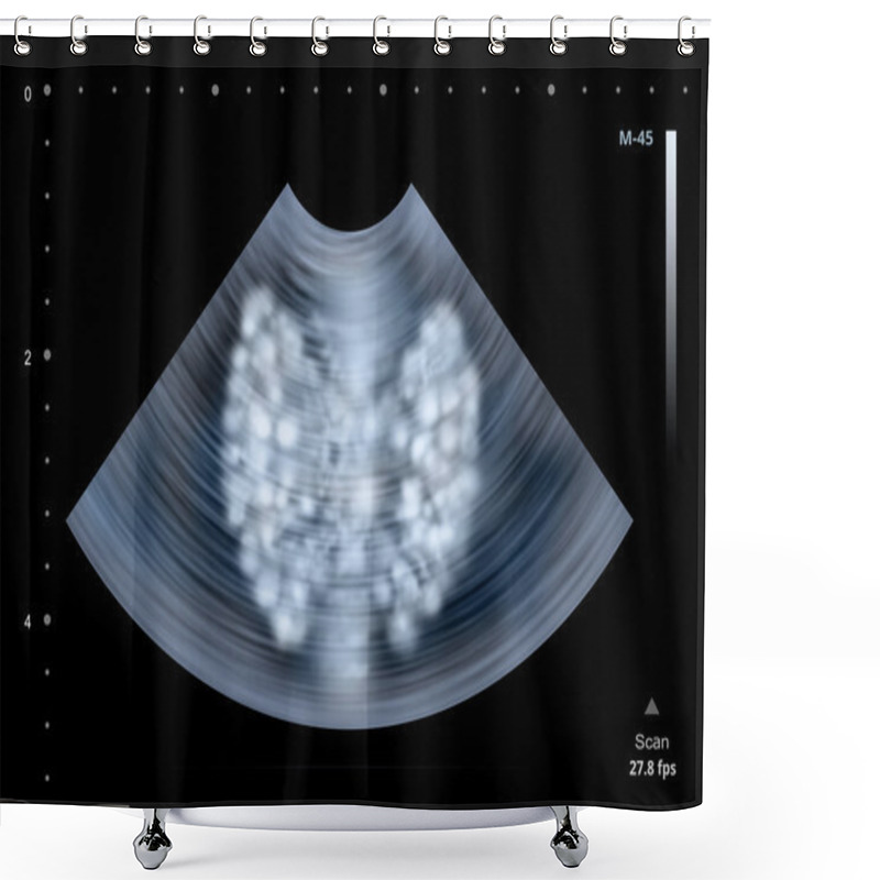 Personality  Ultrasound Scan Of Human Thyroid Gland. Illustration Shower Curtains