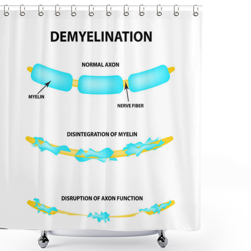 Personality  The Destruction Of The Myelin Sheath On The Axon. Damaged Myelin. Neuron Affected By Multiple Sclerosis. World Multiple Sclerosis Day. Infographics. Vector Illustration On Isolated Background. Shower Curtains