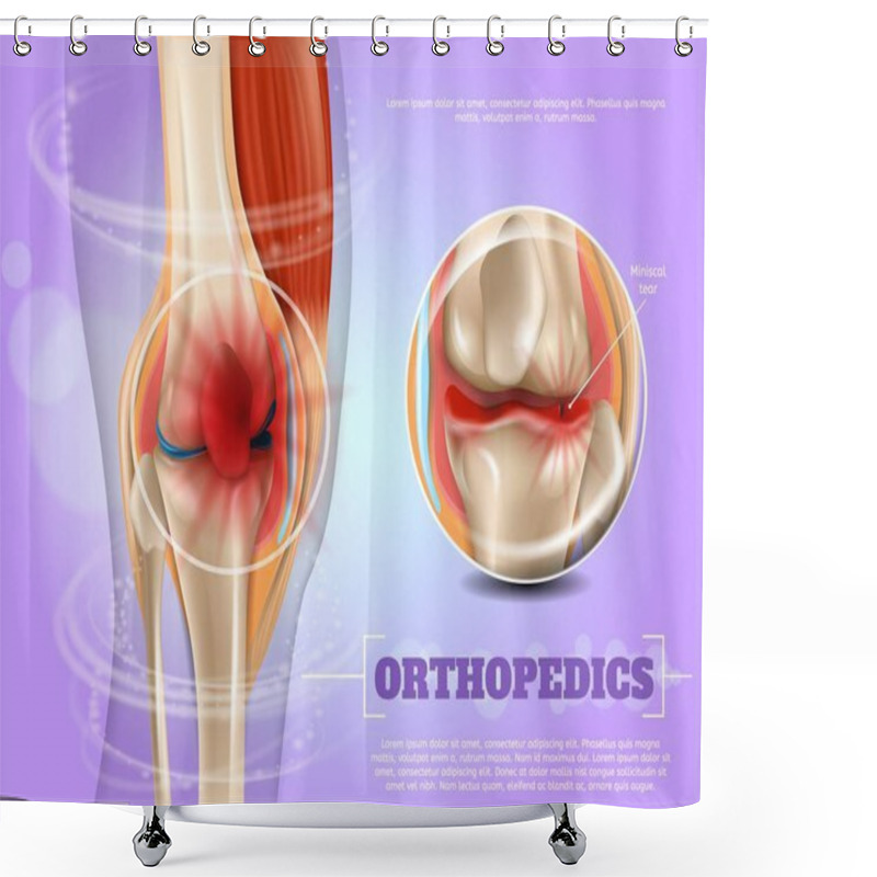 Personality  Realistic Illustration Orthopedics Medicine In 3d Shower Curtains