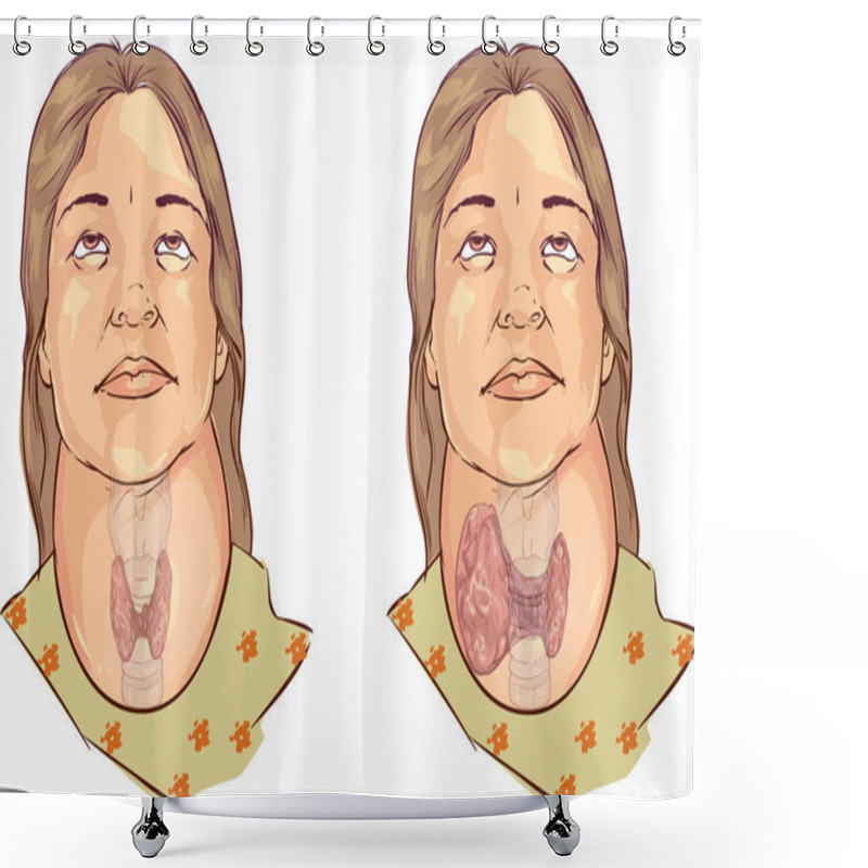 Personality  Vector Illustration Of A Goiter Shower Curtains