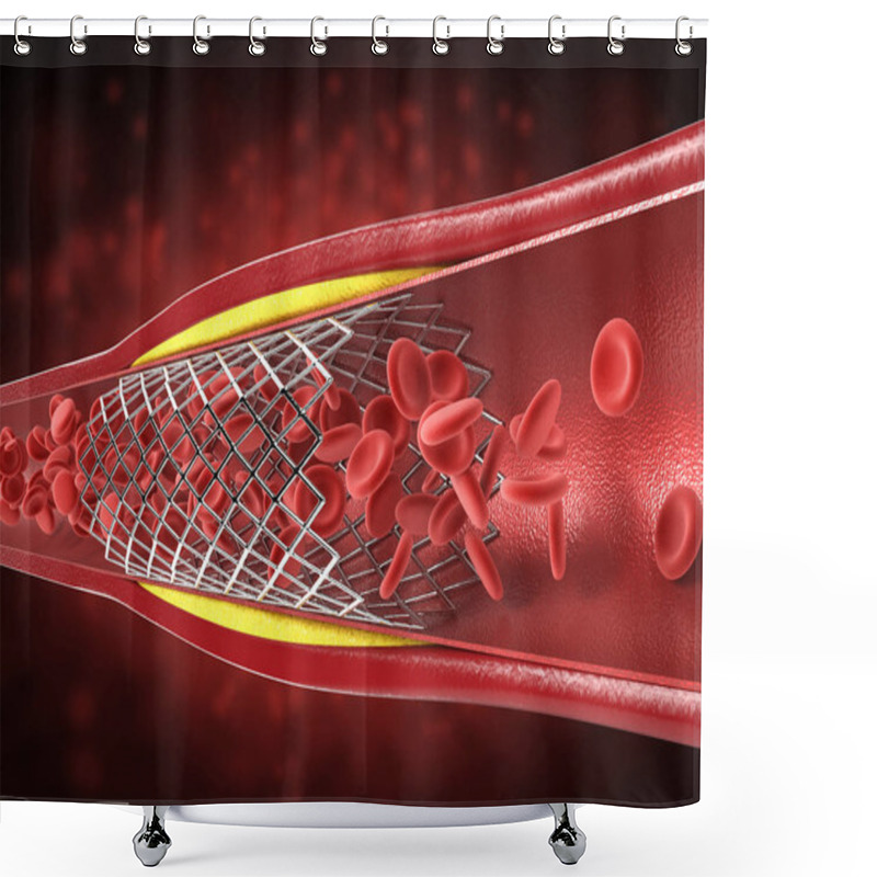 Personality  Balloon Angioplasty Procedure  Shower Curtains