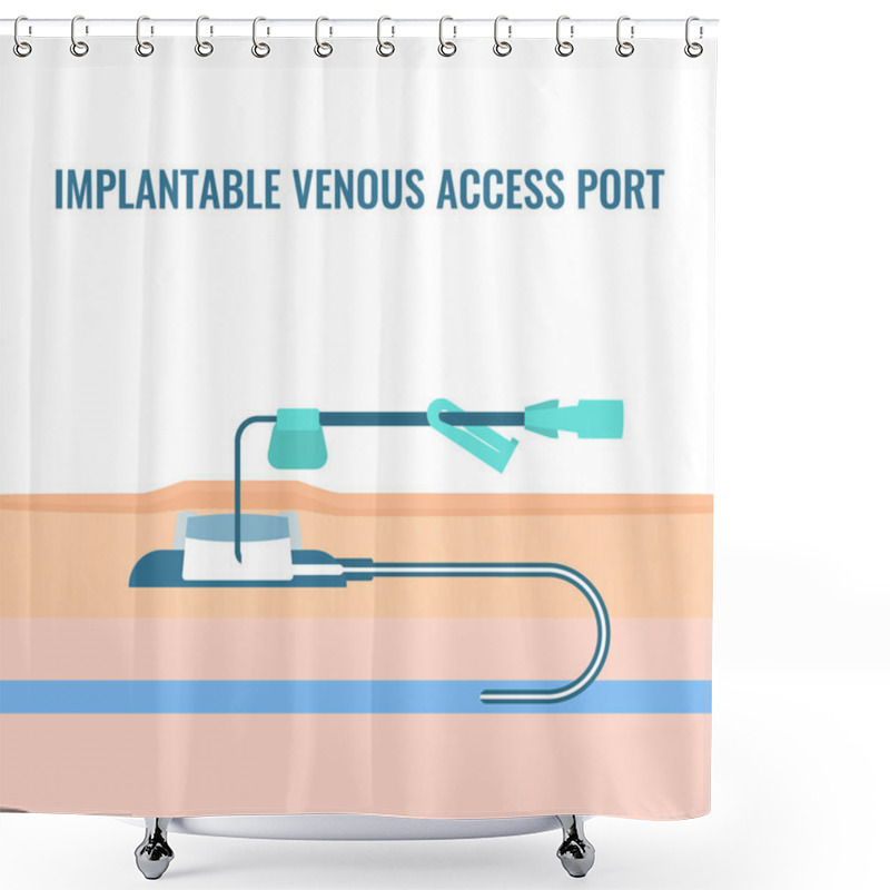 Personality  Implantable Venous Access Port Cross Section. Under The Skin Central Line Access Device For Chemotherapy Infusion, Medication Administration And Blood Drawing. Medical Vector Illustration. Shower Curtains