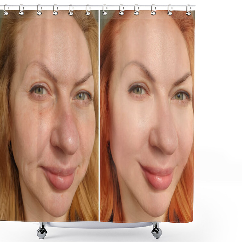 Personality  Woman Face Wrinkles Before And After Treatment Shower Curtains