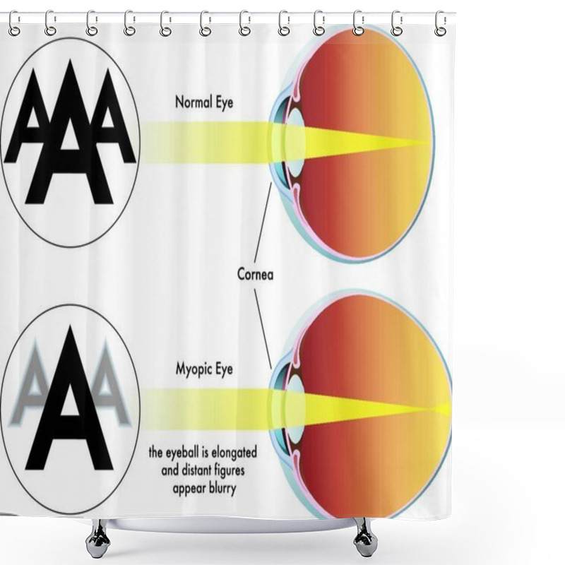 Personality  Medical Illustration Of The Symptoms Of Myopia Shower Curtains