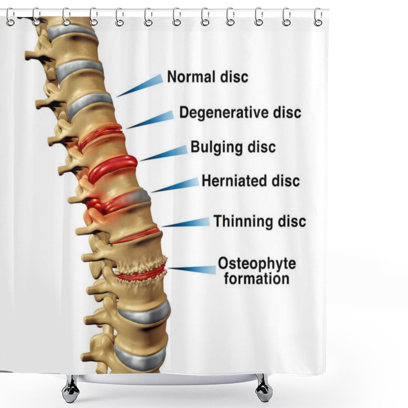 Personality  Spine Disorders Back Pain Concept With Degenerative Disc Or Bulging And Herniated Or Thinning Discs And Osteophyte Formation On A Skeletal Vertebra As A Close Up Of A Vertabrate. Shower Curtains