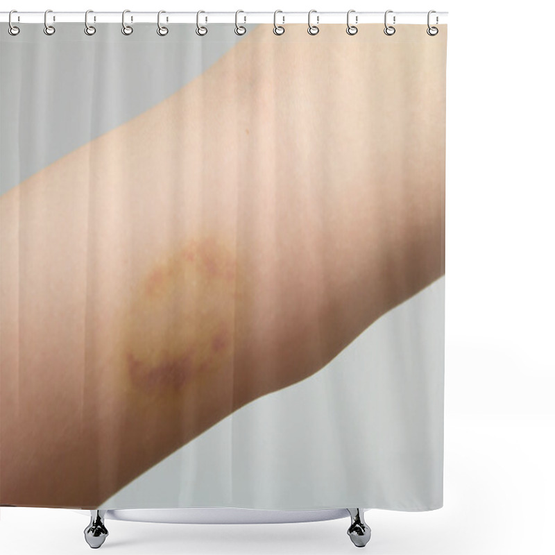 Personality  Bruise On Wound Female Arm Shower Curtains