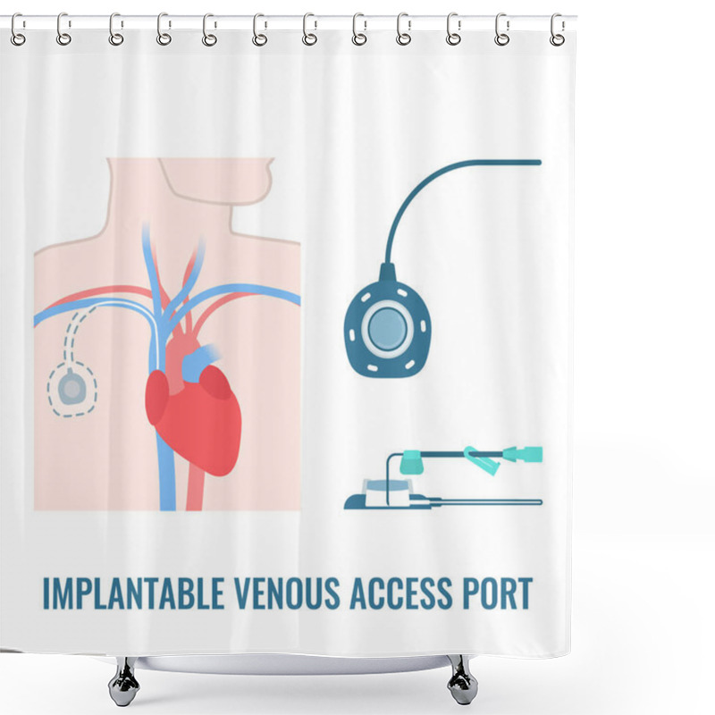 Personality  Implantable Venous Access Port. Under The Skin Central Line Access Device For Chemotherapy Infusion, Medication Administration And Blood Drawing. Medical Vector Illustration. Shower Curtains