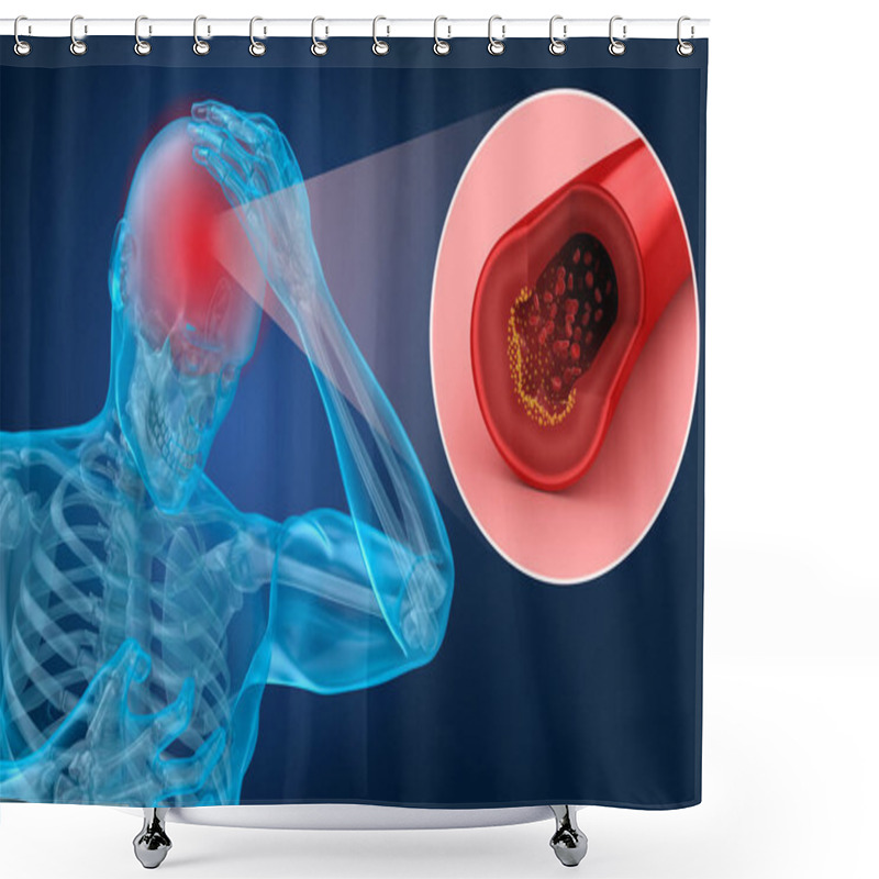 Personality  Brain Stroke : 3d Illustration Of The Vessels Of The Brain And Causes Of Stroke Shower Curtains