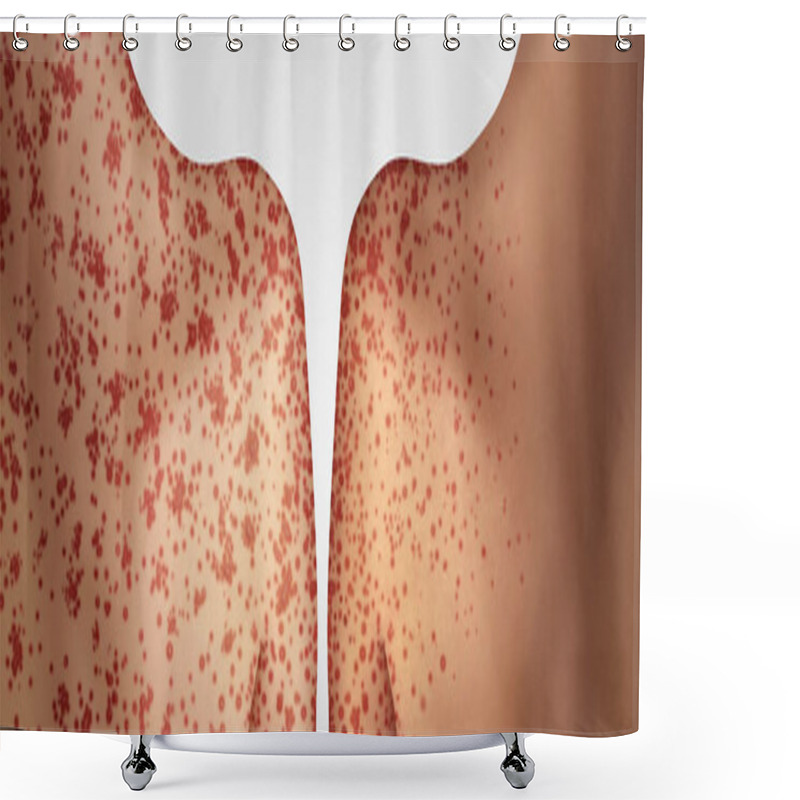 Personality  Transmission Of Measles Shower Curtains