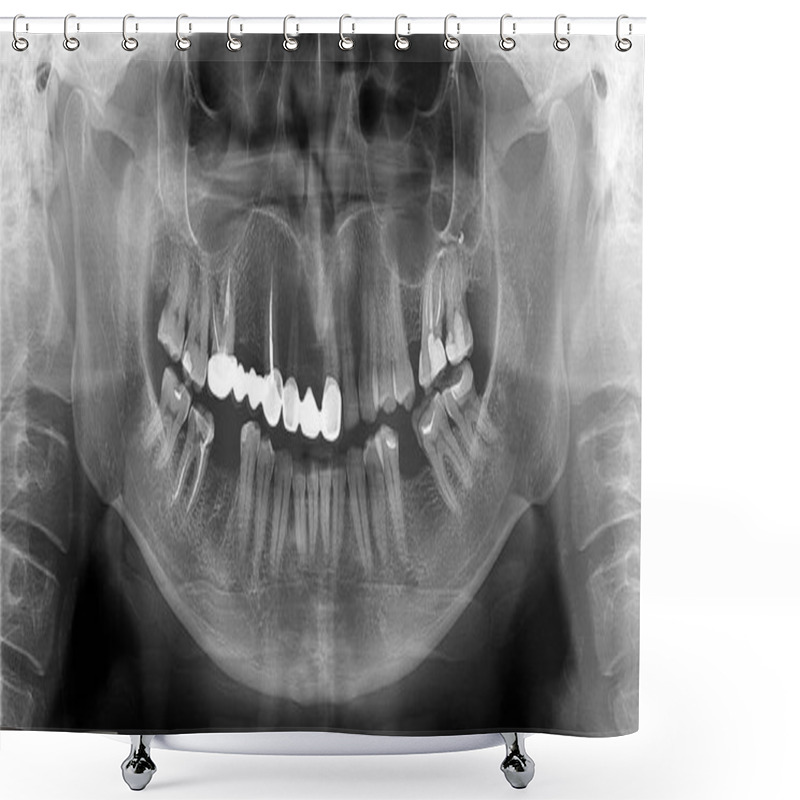 Personality  A Panoramic Radiograph Is A Panoramic Scanning Dental X-ray Of The Upper And Lower Jaw. This Is A Focal Plane Tomography Shows The Maxilla And Mandible Of A Forty Year Old Man. Shower Curtains