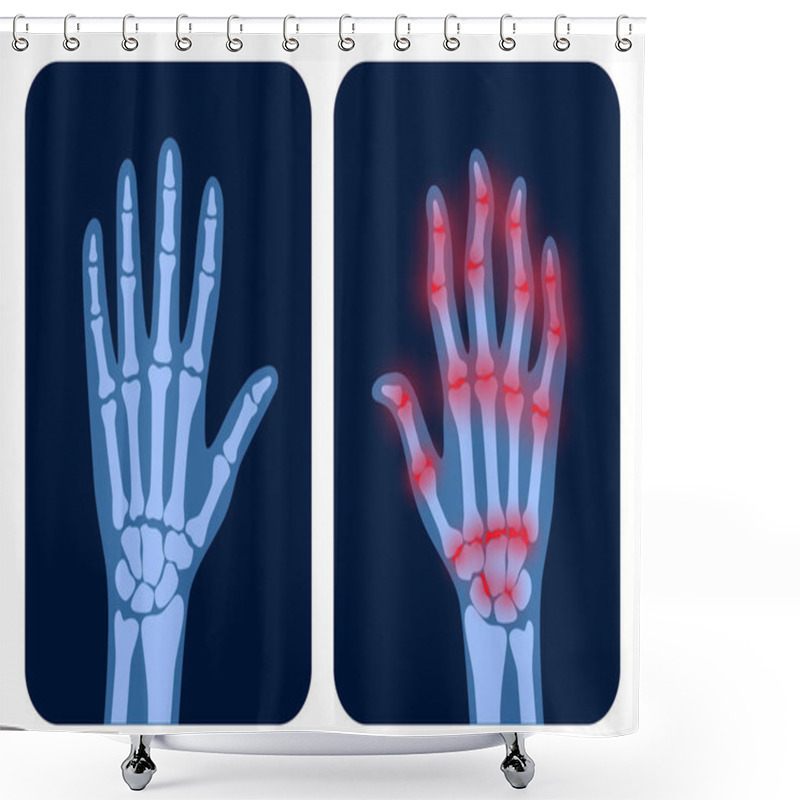 Personality  Arthrits X Ray Shower Curtains