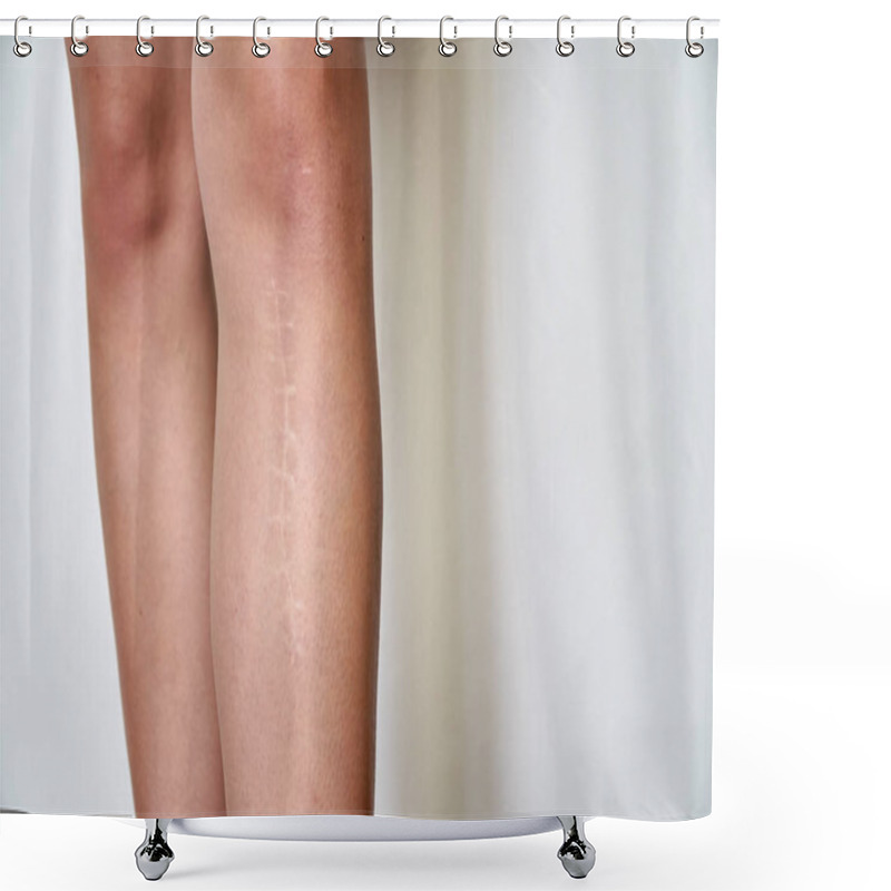 Personality  The Scar On The Leg. Bone Fracture Or Tumor Removal. Recobvery. Isolated Medical On White Background Shower Curtains